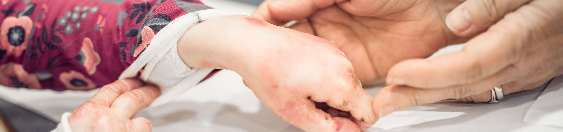 Physician at the EB House examines the hand of a butterfly child 